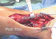 صورة طبية: كسر البيلون ORIF: إعادة بناء مفصل الكاحل بدقة متناهية مع الأستاذ الدكتور محمد هطيف في صنعاء