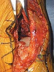 صورة توضيحية لـ كسر البيلون ORIF: إعادة بناء مفصل الكاحل بدقة متناهية مع الأستاذ الدكتور محمد هطيف في صنعاء