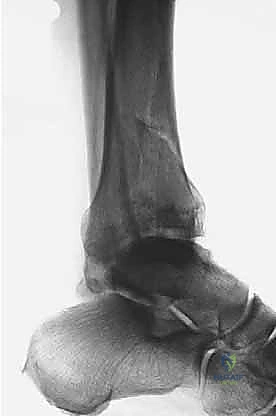 صورة طبية: كسر البيلون ORIF: إعادة بناء مفصل الكاحل بدقة متناهية مع الأستاذ الدكتور محمد هطيف في صنعاء