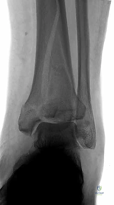 صورة توضيحية لـ كسر البيلون ORIF: إعادة بناء مفصل الكاحل بدقة متناهية مع الأستاذ الدكتور محمد هطيف في صنعاء