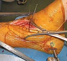 صورة طبية: كسر البيلون ORIF: إعادة بناء مفصل الكاحل بدقة متناهية مع الأستاذ الدكتور محمد هطيف في صنعاء