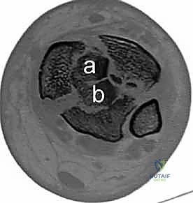 صورة طبية: كسر البيلون ORIF: إعادة بناء مفصل الكاحل بدقة متناهية مع الأستاذ الدكتور محمد هطيف في صنعاء