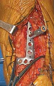 صورة توضيحية لـ كسر البيلون ORIF: إعادة بناء مفصل الكاحل بدقة متناهية مع الأستاذ الدكتور محمد هطيف في صنعاء