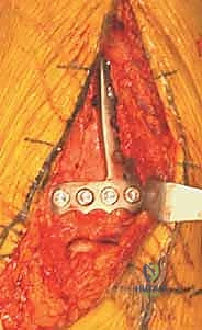 صورة طبية: كسر البيلون ORIF: إعادة بناء مفصل الكاحل بدقة متناهية مع الأستاذ الدكتور محمد هطيف في صنعاء