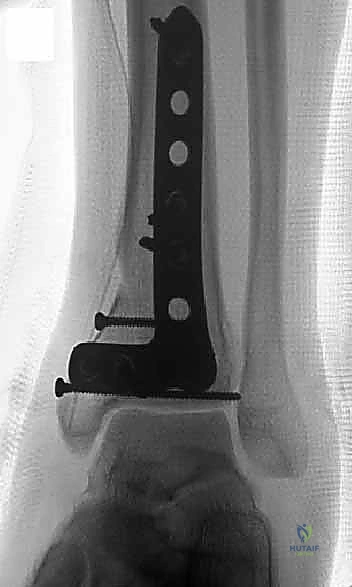 تخطيط الشقوق الجراحية على الجلد مع مراعاة الجسور الجلدية