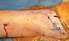 صورة طبية: كسر البيلون ORIF: إعادة بناء مفصل الكاحل بدقة متناهية مع الأستاذ الدكتور محمد هطيف في صنعاء