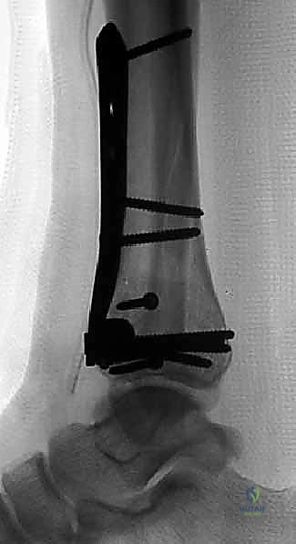 صورة توضيحية لـ كسر البيلون ORIF: إعادة بناء مفصل الكاحل بدقة متناهية مع الأستاذ الدكتور محمد هطيف في صنعاء