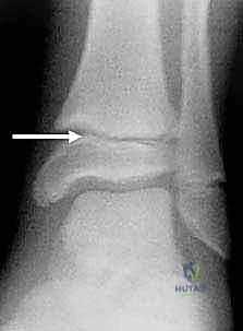 Pediatric Ankle Fractures: An Intraoperative Masterclass on Surgical Management