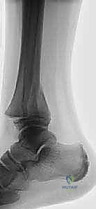 تشريح مفصل الكاحل عند الأطفال