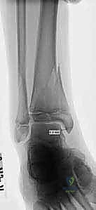 حدبة كومب وتأثيرها على نمو العظم