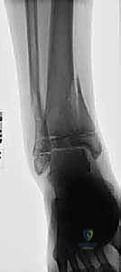 تأثير الأربطة على كسور الأطفال