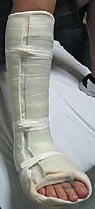 صورة طبية: كسور كاحل الأطفال: دليلك الشامل للعلاج الجراحي المتقن في صنعاء مع الأستاذ الدكتور محمد هطيف