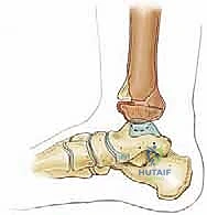 صورة طبية: كسور كاحل الأطفال: دليلك الشامل للعلاج الجراحي المتقن في صنعاء مع الأستاذ الدكتور محمد هطيف