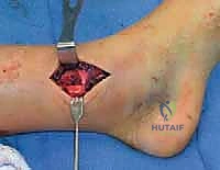 تصنيف سالتر هاريس لكسور الأطفال