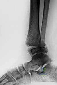 التشخيص الإشعاعي المتقدم لكسور الكاحل