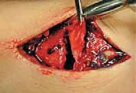 أسباب كسور الكاحل عند الأطفال