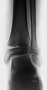 كسر تيلوكس للمراهقين