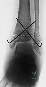 صورة طبية: كسور كاحل الأطفال: دليلك الشامل للعلاج الجراحي المتقن في صنعاء مع الأستاذ الدكتور محمد هطيف
