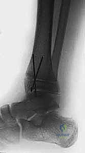 العلاج التحفظي بالجبس