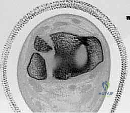 مقارنة بين العلاج الجراحي والتحفظي