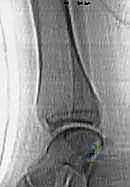 صورة توضيحية لـ كسور كاحل الأطفال: دليلك الشامل للعلاج الجراحي المتقن في صنعاء مع الأستاذ الدكتور محمد هطيف