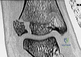 كسور كاحل الأطفال: دليلك الشامل للعلاج الجراحي المتقن في صنعاء مع الأستاذ الدكتور محمد هطيف