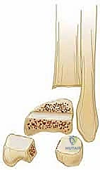 صورة توضيحية لـ كسور كاحل الأطفال: دليلك الشامل للعلاج الجراحي المتقن في صنعاء مع الأستاذ الدكتور محمد هطيف