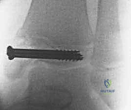 صورة توضيحية لـ كسور كاحل الأطفال: دليلك الشامل للعلاج الجراحي المتقن في صنعاء مع الأستاذ الدكتور محمد هطيف