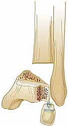 صورة توضيحية لـ كسور كاحل الأطفال: دليلك الشامل للعلاج الجراحي المتقن في صنعاء مع الأستاذ الدكتور محمد هطيف