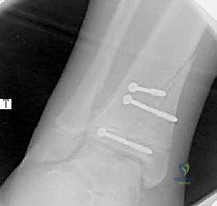 صورة توضيحية لـ كسور كاحل الأطفال: دليلك الشامل للعلاج الجراحي المتقن في صنعاء مع الأستاذ الدكتور محمد هطيف