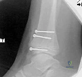 صورة توضيحية لـ كسور كاحل الأطفال: دليلك الشامل للعلاج الجراحي المتقن في صنعاء مع الأستاذ الدكتور محمد هطيف