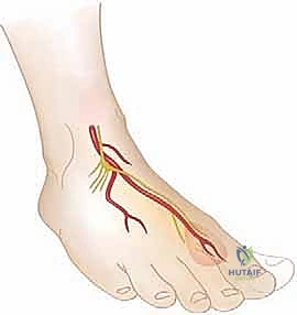 صورة طبية: كسور كاحل الأطفال: دليلك الشامل للعلاج الجراحي المتقن في صنعاء مع الأستاذ الدكتور محمد هطيف