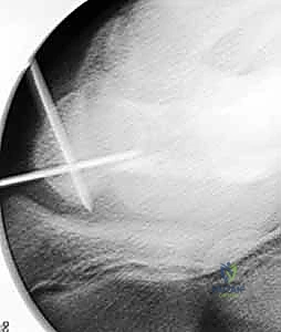 التشخيص الإشعاعي لعدم التئام العظم الزورقي