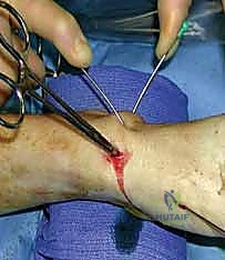 إدخال السلك الدليلي تحت الأشعة في تقنية التدخل المحدود