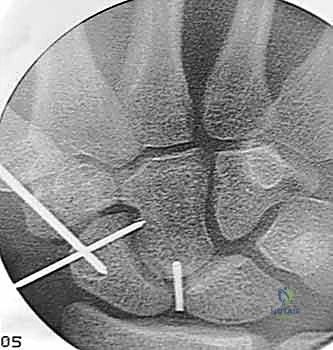 علاج عدم التئام العظم الزورقي بالتدخل المحدود الحل الأمثل لآلام الرسغ في صنعاء مع الأستاذ الدكتور محمد هطيف