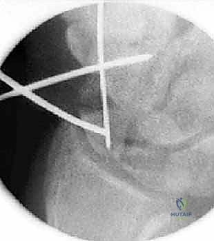 صورة توضيحية لـ علاج عدم التئام العظم الزورقي بالتدخل المحدود الحل الأمثل لآلام الرسغ في صنعاء مع الأستاذ الدكتور محمد هطيف