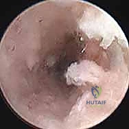 صورة توضيحية لـ علاج عدم التئام العظم الزورقي بالتدخل المحدود الحل الأمثل لآلام الرسغ في صنعاء مع الأستاذ الدكتور محمد هطيف