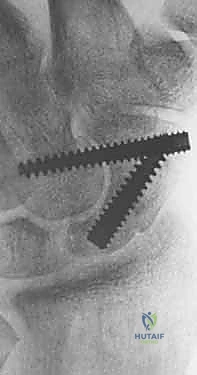 صورة توضيحية لـ علاج عدم التئام العظم الزورقي بالتدخل المحدود الحل الأمثل لآلام الرسغ في صنعاء مع الأستاذ الدكتور محمد هطيف