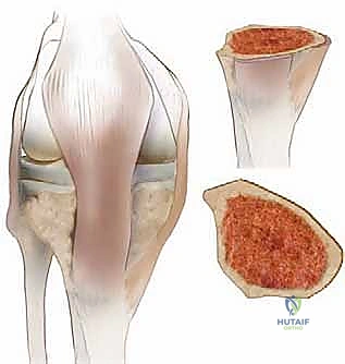 تأثير تقوس الساقين على الغضاريف