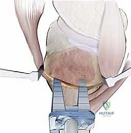 الألم الميكانيكي في الركبة