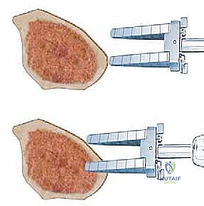 أعراض خشونة الركبة المبكرة