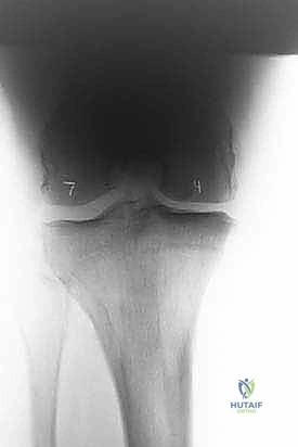 بدائل استبدال المفصل