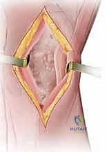 المرضى المرشحون لعملية HTO