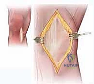 تقييم زوايا الركبة قبل الجراحة