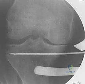 صورة طبية: عملية قطع عظم الظنبوب القاصي (HTO): إعادة محاذاة الركبة لاستعادة الحياة النشطة مع الأستاذ الدكتور محمد هطيف