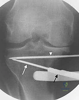 صورة توضيحية لـ عملية قطع عظم الظنبوب القاصي (HTO): إعادة محاذاة الركبة لاستعادة الحياة النشطة مع الأستاذ الدكتور محمد هطيف