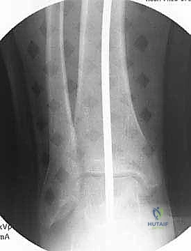 صورة توضيحية لـ عملية قطع عظم الظنبوب القاصي (HTO): إعادة محاذاة الركبة لاستعادة الحياة النشطة مع الأستاذ الدكتور محمد هطيف