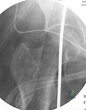 صورة توضيحية لـ عملية قطع عظم الظنبوب القاصي (HTO): إعادة محاذاة الركبة لاستعادة الحياة النشطة مع الأستاذ الدكتور محمد هطيف