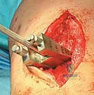 صورة طبية: عملية قطع عظم الظنبوب القاصي (HTO): إعادة محاذاة الركبة لاستعادة الحياة النشطة مع الأستاذ الدكتور محمد هطيف