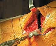 صورة طبية: عملية قطع عظم الظنبوب القاصي (HTO): إعادة محاذاة الركبة لاستعادة الحياة النشطة مع الأستاذ الدكتور محمد هطيف